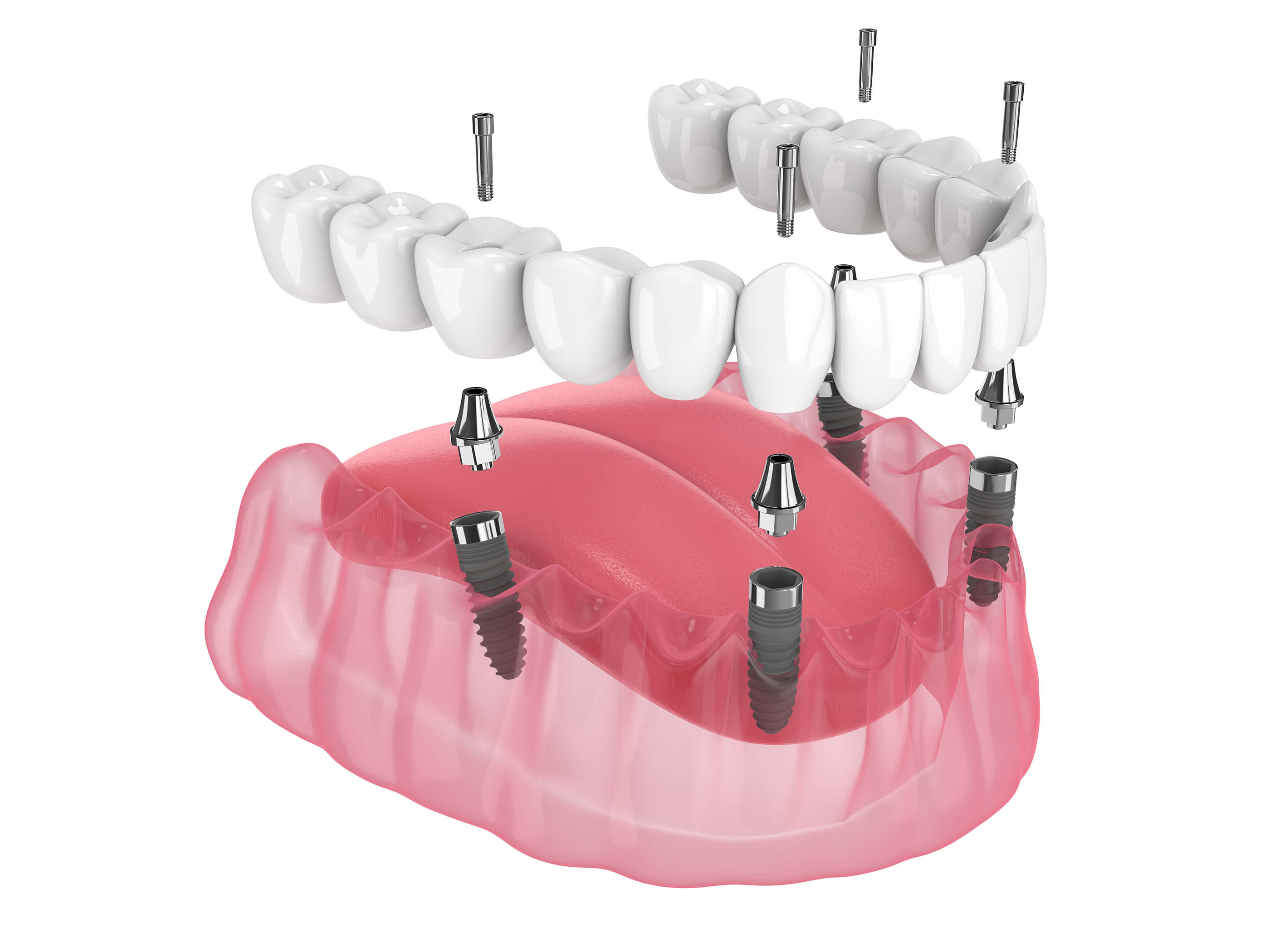 dental implants Temecula, CA